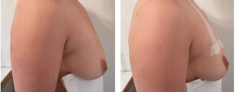 Enne ja pärast niiti rindade tõstmine