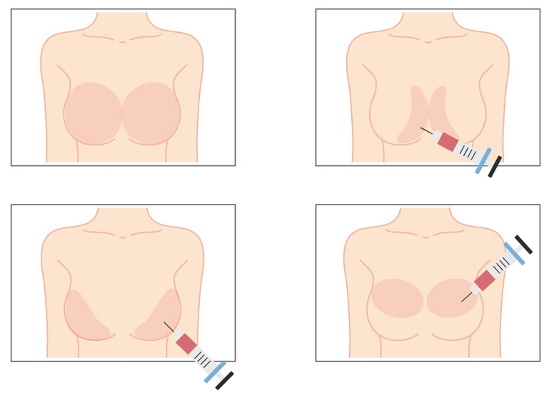 Kohad hüaluroonhappe süstimiseks rinda