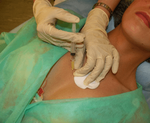 Mesokokteili sisseviimine rinnakoesse – alternatiiv hüaluroonhappe süstidele