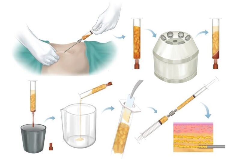 Rasva eemaldamine probleemsetest piirkondadest, töötlemine ja süstimine rinnakoesse