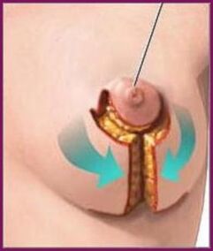 Periareolaarne implantatsioon rinna